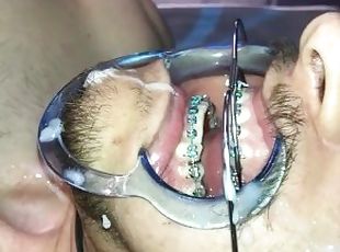 Cuming on Headgear braces